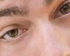 صحة وطب : أعراض وأسباب غير شائعة لالتهابات جفن العين