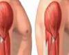 صحة وطب : أشهر أسباب وأعراض تيبس العضلات