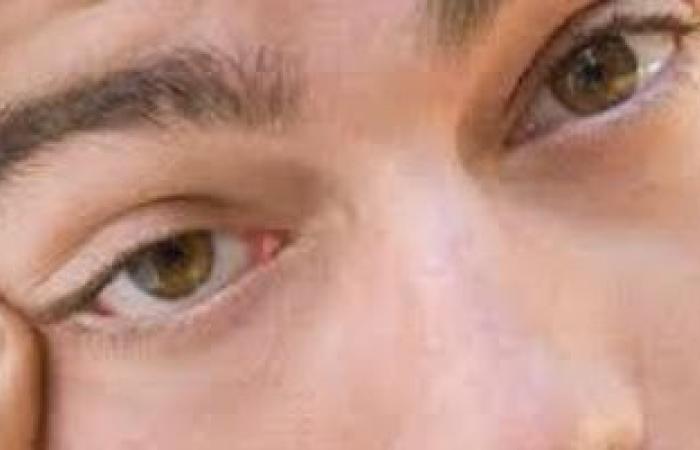 صحة وطب : أعراض وأسباب غير شائعة لالتهابات جفن العين