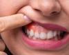 صحة وطب : علامات ظاهرة وعوامل تزيد فرص الإصابة بتقرحات الفم والشفاه